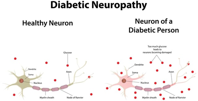 neuropathy_diagram.jpg
