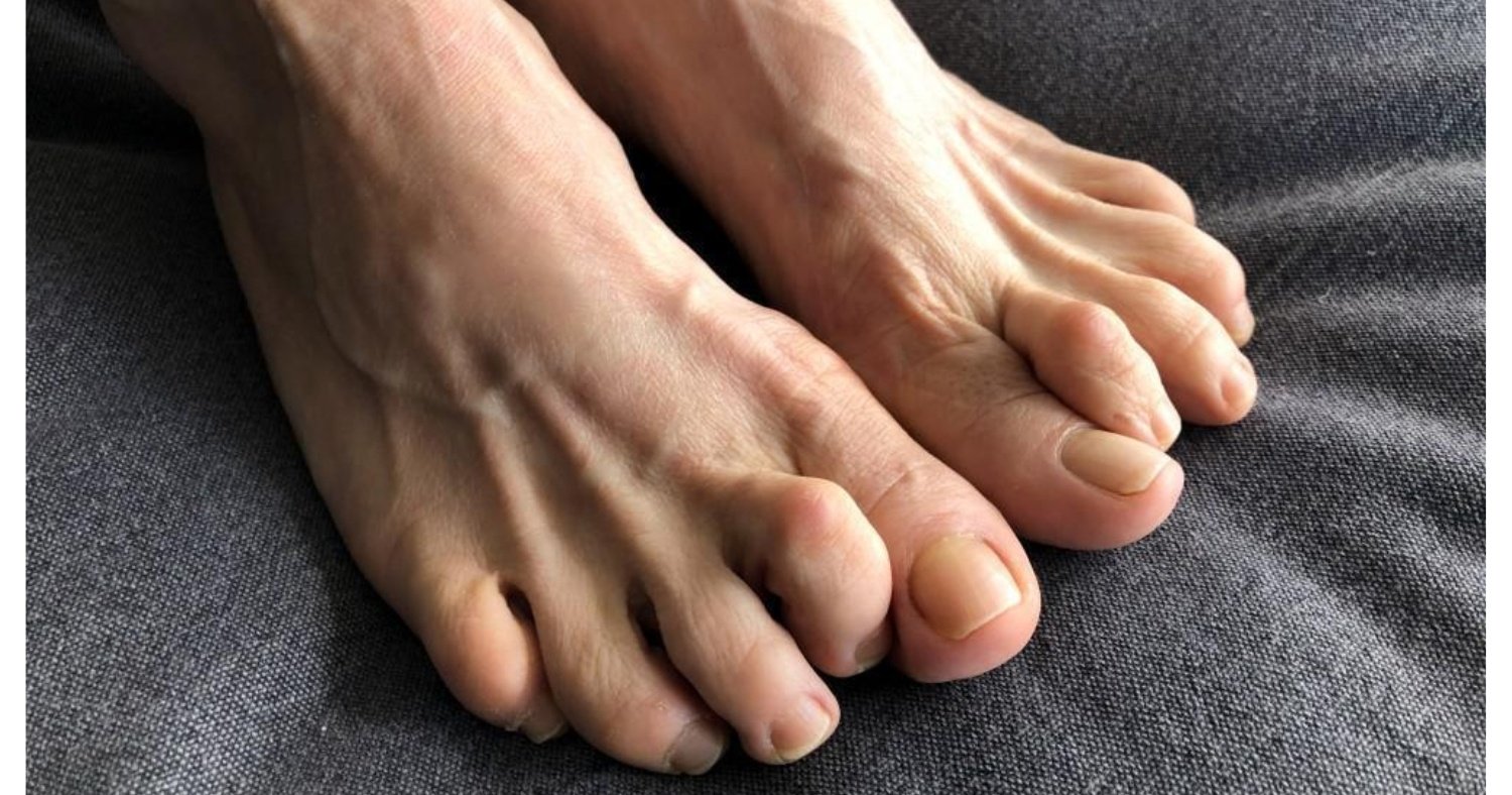 Say Goodbye to Hammertoe Pain: A Comprehensive Guide
